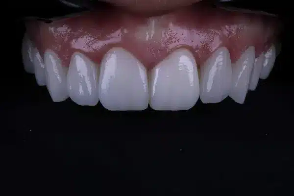 after digital smile transformation